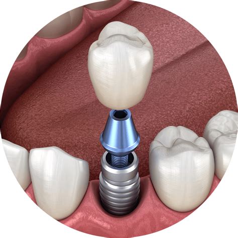 Will dental implants get cheaper in the future?