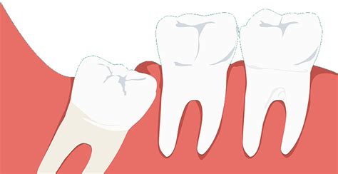 Why experts now say not to remove your wisdom teeth?