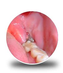 Can wisdom teeth surgery cause lockjaw?