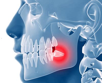 How do you treat trismus after wisdom teeth removal?