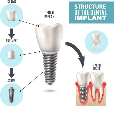 How painful are full dental implants?