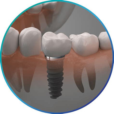 What age should you not get dental implants?
