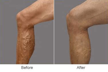How can I increase blood flow to my varicose veins?