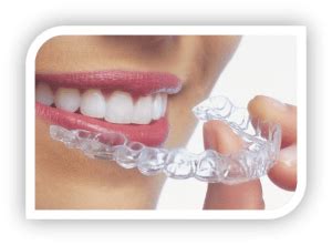 Which type of braces takes longer?