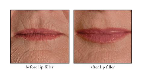 How long does it take for lips to fully heal after filler?