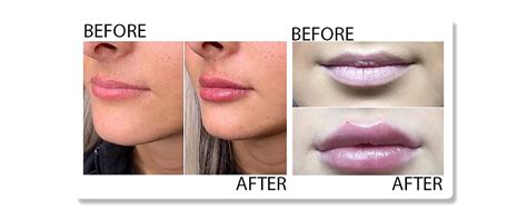 How long are lips lumpy after filler?