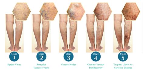 Why do health care workers get varicose veins?