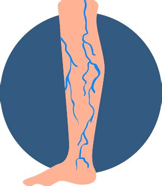 What syndrome is associated with varicose veins?