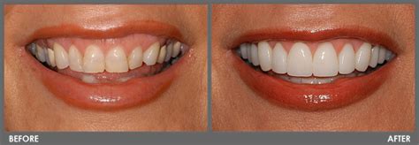 What to do if veneers are too big?