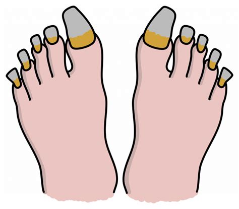 What is the worse case of ingrown toenail?