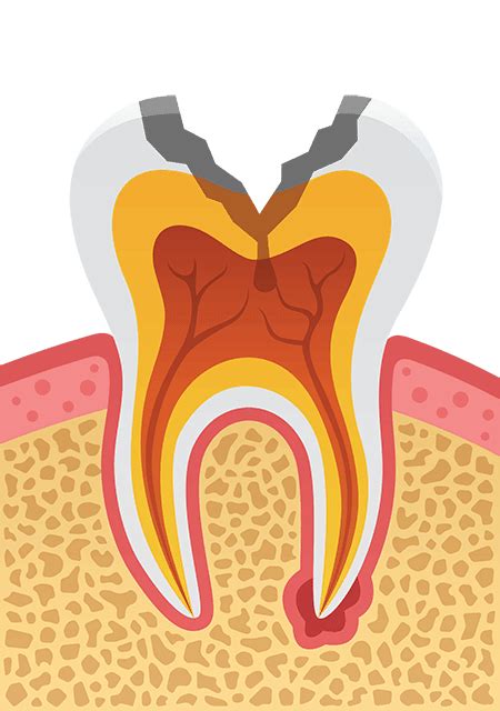 How many cavities does average 30 year old have?