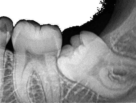 How painful is wisdom teeth removal?