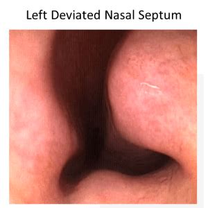 Are there stitches inside nose after septoplasty?